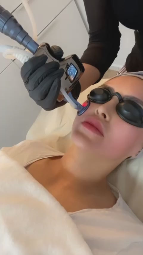 RAYTONE ULTRA – Ultra-Pulsed Fractional CO2 Laser Professional Workstation